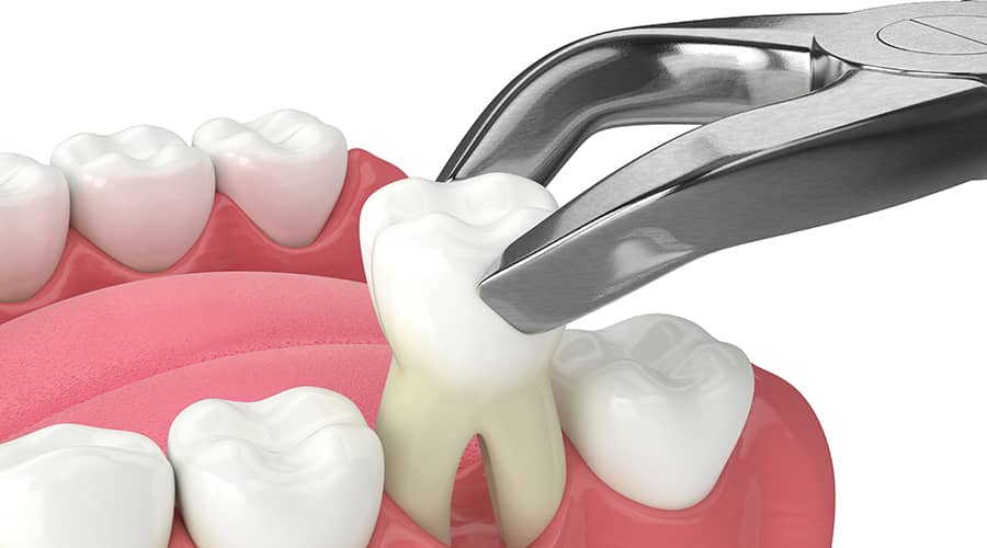 after tooth extraction