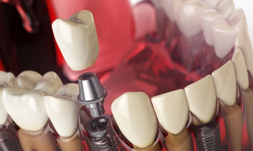 dental crown frisco, tx, north frisco dental & orthodontics