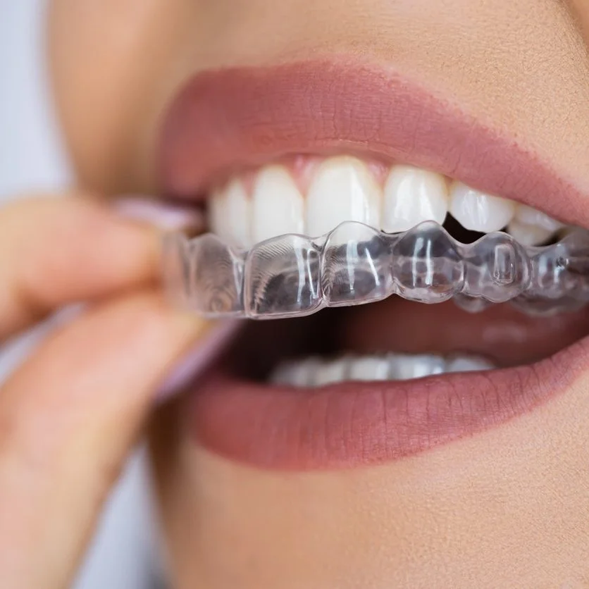 invisalign appointments 1 836x836