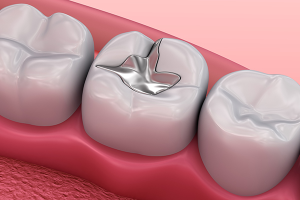 metall,dental,fillings,,medically,accurate,3d,illustration