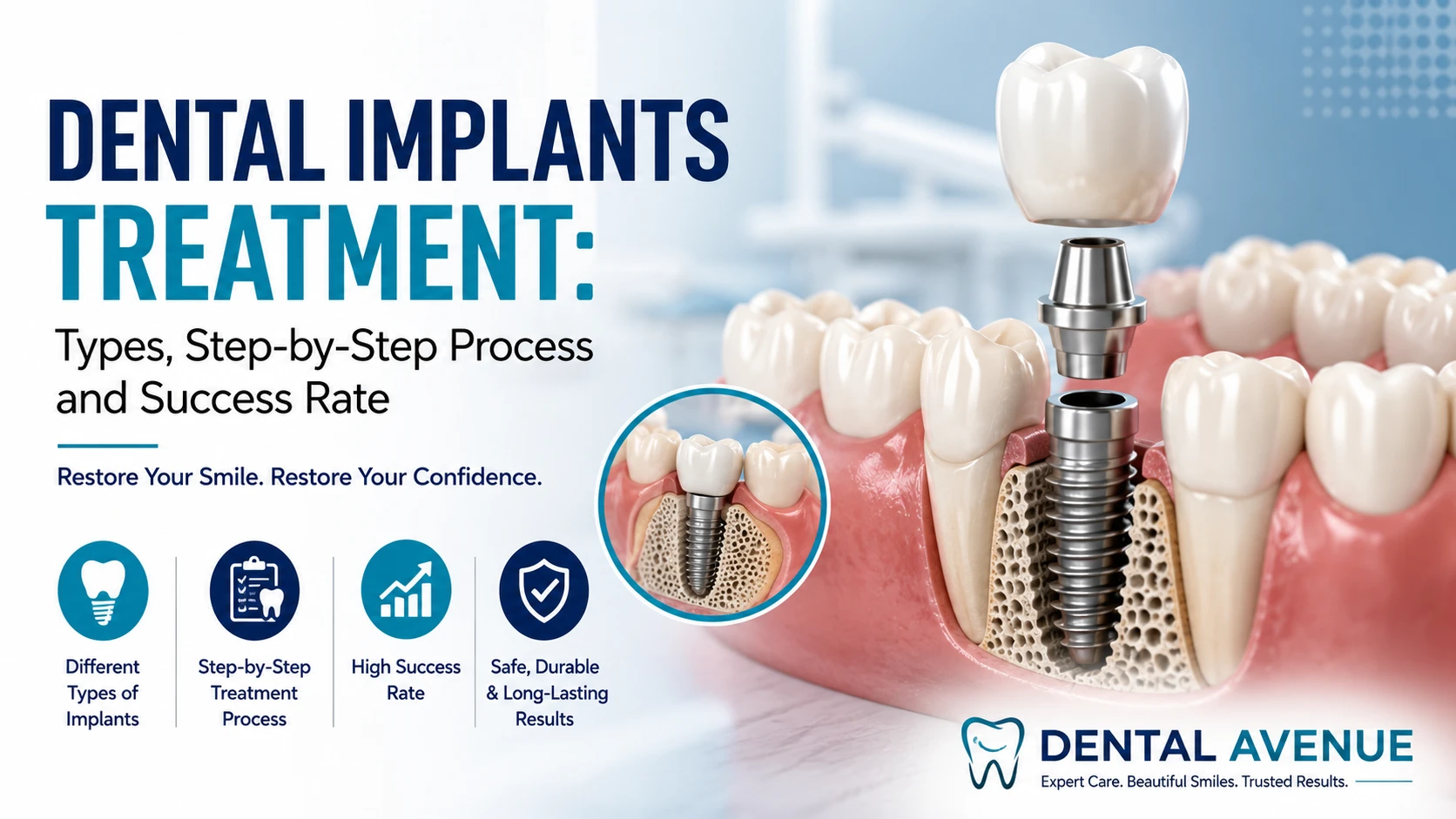Dental Implants Treatment